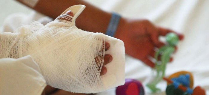 Reportan 128 casos de quemados con pólvora durante noche de velitas en Colombia