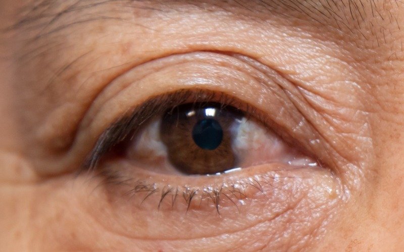 ¿Qué es y por qué aparece la carnosidad en los ojos?