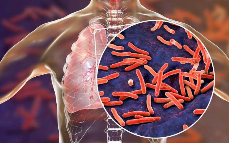 Brote de tuberculosis en Kansas City deja 2 fallecidos