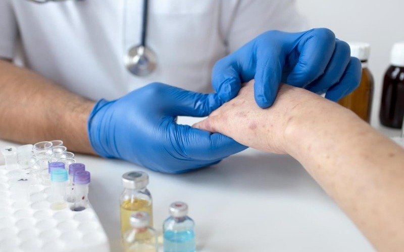Expertos presentan en México una campaña que busca visibilizar el impacto de la psoriasis