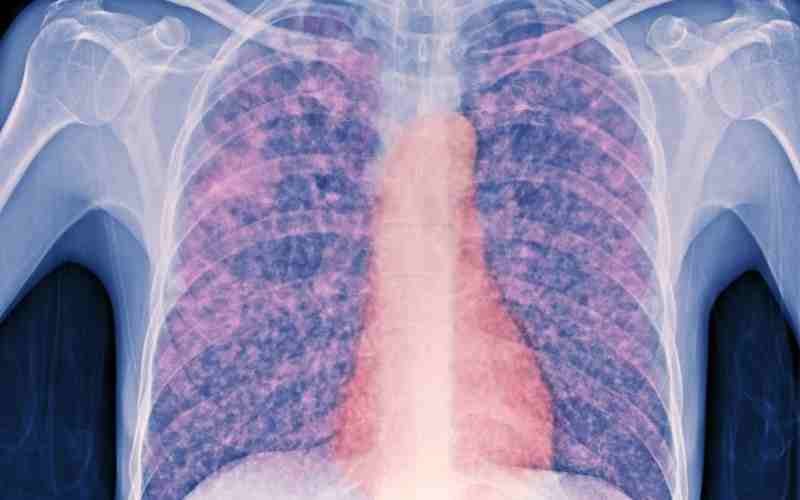 Perú incrementa a 90 % el éxito del tratamiento contra la tuberculosis resistente
