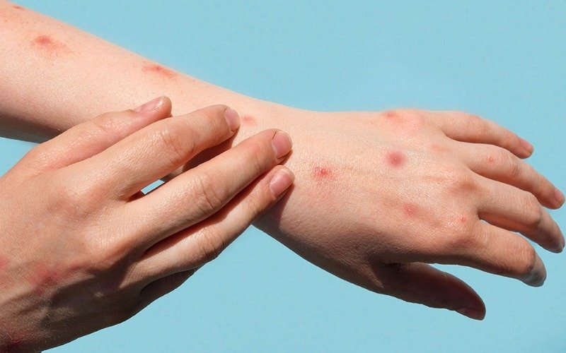 Sudán del Sur declaró brote de mpox tras confirmar el primer caso en Yuba