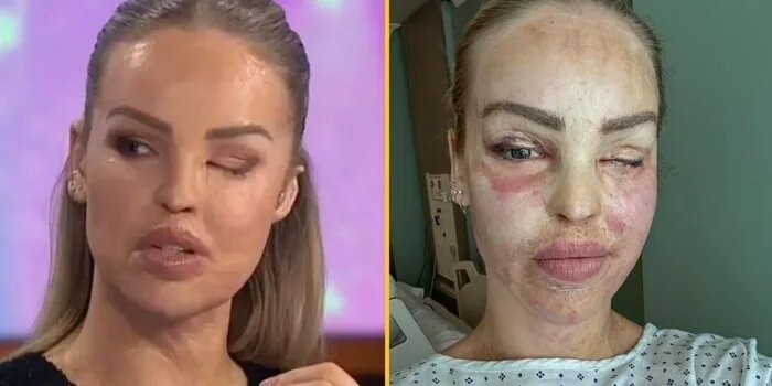 Presentadora de TV que fue atacada con ácido cuenta la pesadilla que vivió