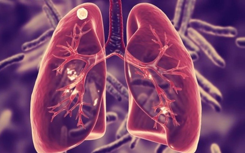 Millones de vidas peligran por tuberculosis tras cesar financiamiento de EE. UU.