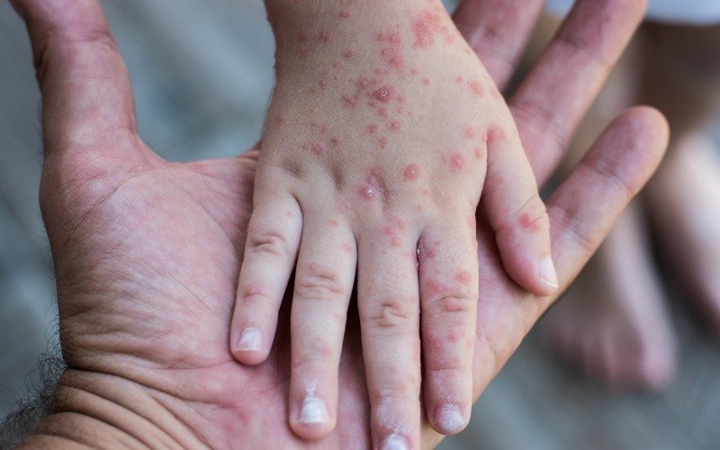 OPS emite alerta epidemiológica por sarampión ante aumento de casos