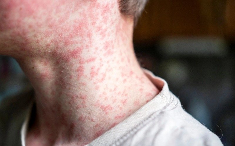 Vietnam alerta sobre la propagación de sarampión y urge a acelerar la vacunación
