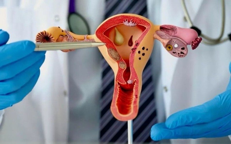 Alimentos que alivian la endometriosis