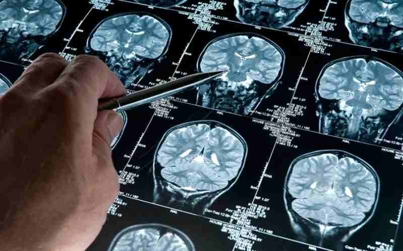 Análisis de sangre permite detectar el Alzheimer con anticipación
