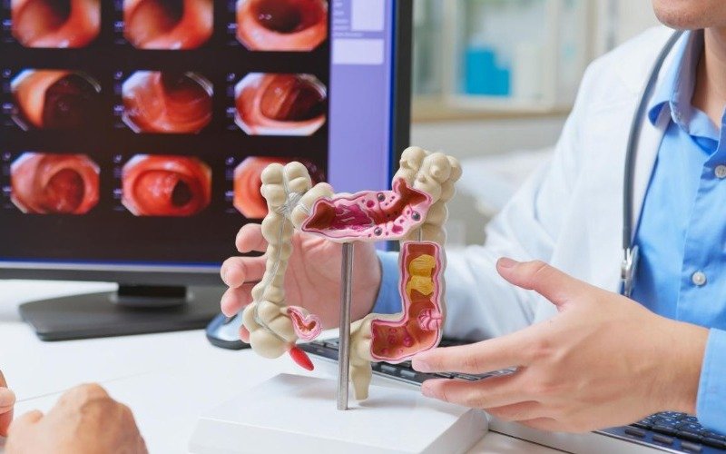 Aumento de cáncer colorrectal en jóvenes podría deberse a una infección en la infancia