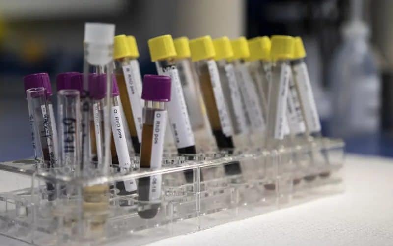 Test en sangre diagnostica el Alzheimer y mide el grado de avance de la enfermedad
