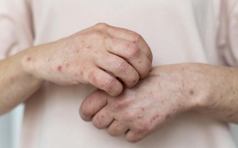 Andalucía suma 5 casos nuevos de sarampión en la última semana