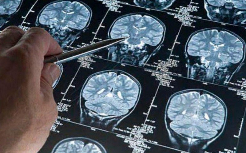 Científicos estudian los mecanismos responsables del avance del alzheimer en el cerebro
